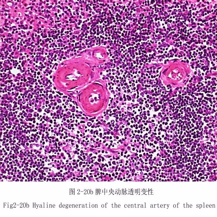 脾中央動脈透明變性